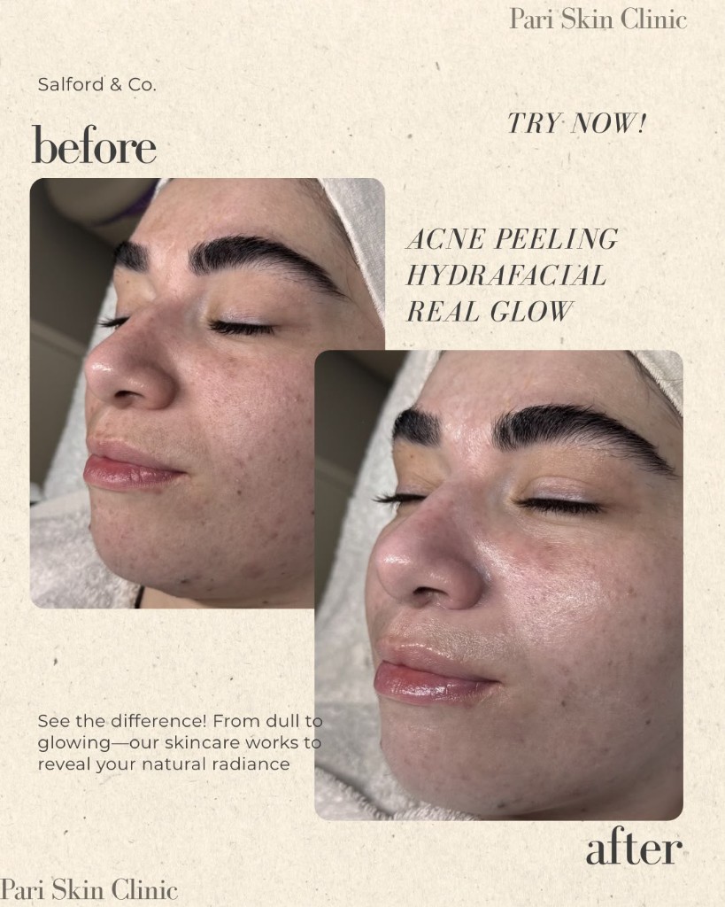 Voor en na acne peeling en Hydrafacial bij Pari Skin Clinic