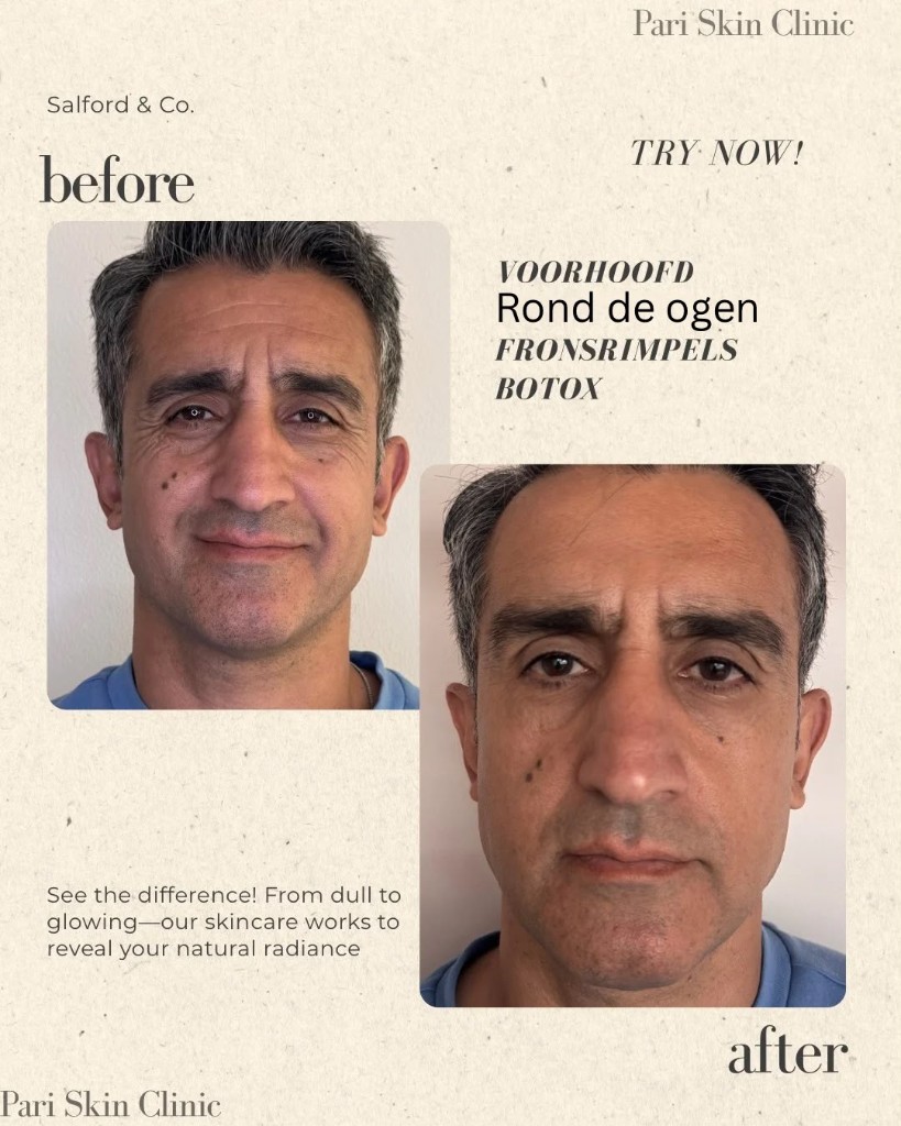 Voor en na Botox voorhoofd en fronsrimpels bij Pari Skin Clinic
