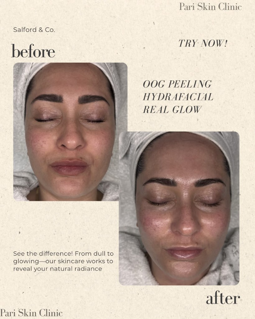 Voor en na oog peeling en Hydrafacial bij Pari Skin Clinic