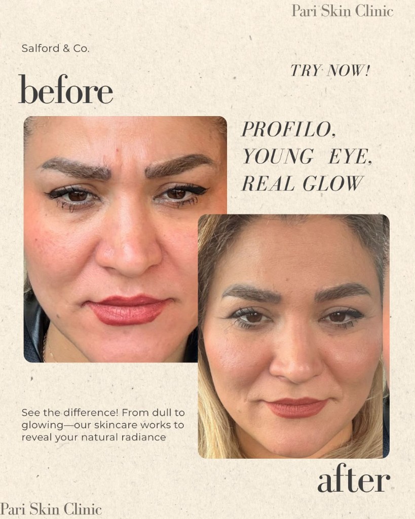 Voor en na Profhilo en Young Eye behandeling bij Pari Skin Clinic